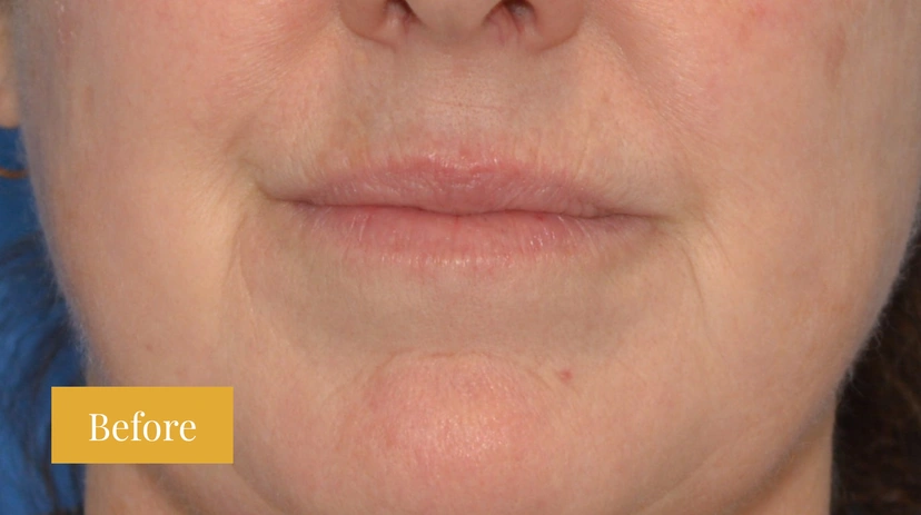 Fraxel - Patient 3 - Set 1 - Before