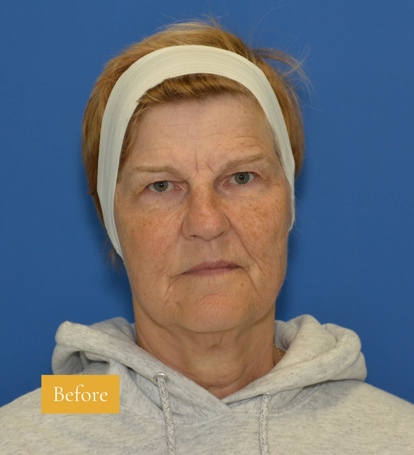Eyebrow Lift - Patient 4 - Set 1 - Before