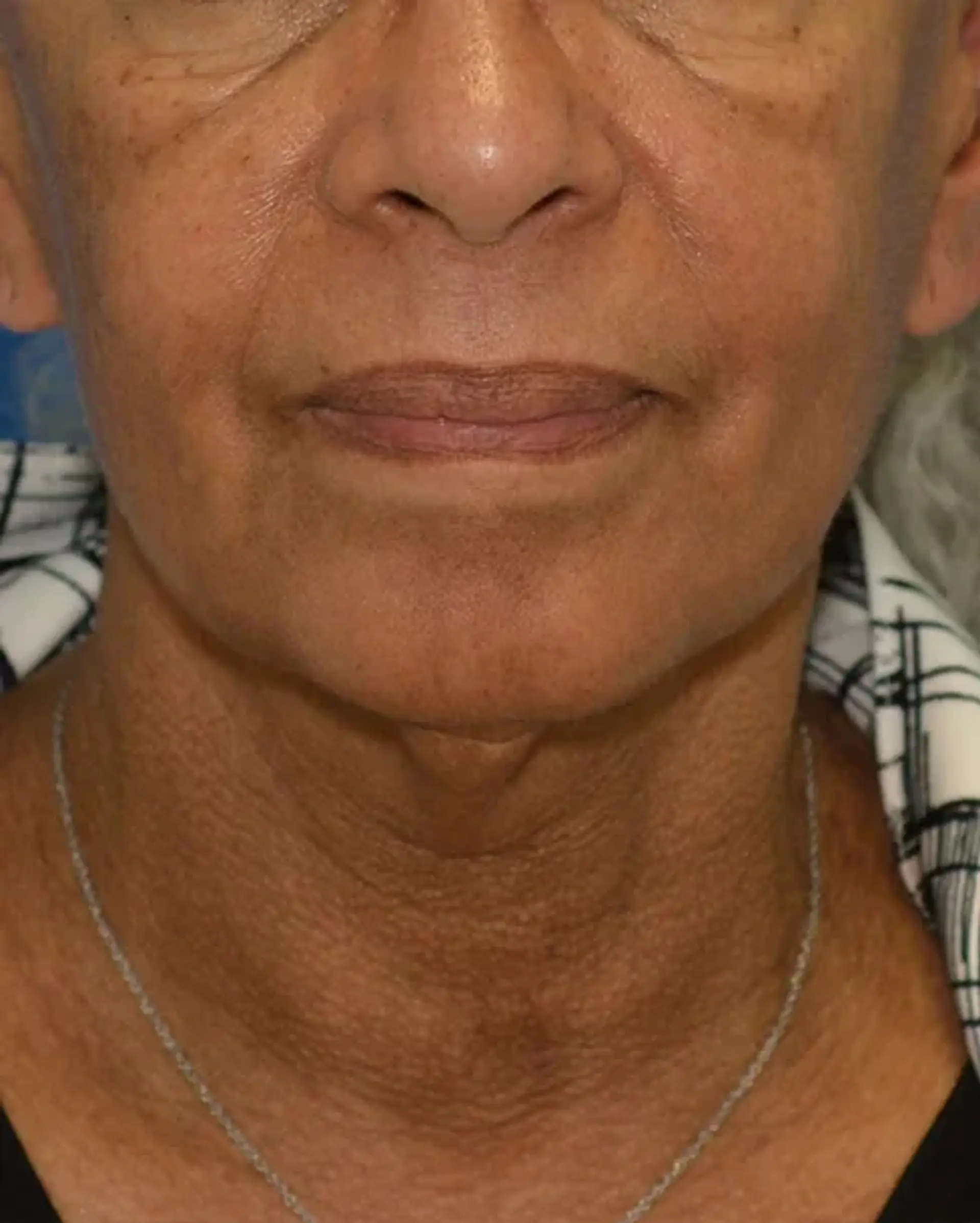 Before Facelift before and after