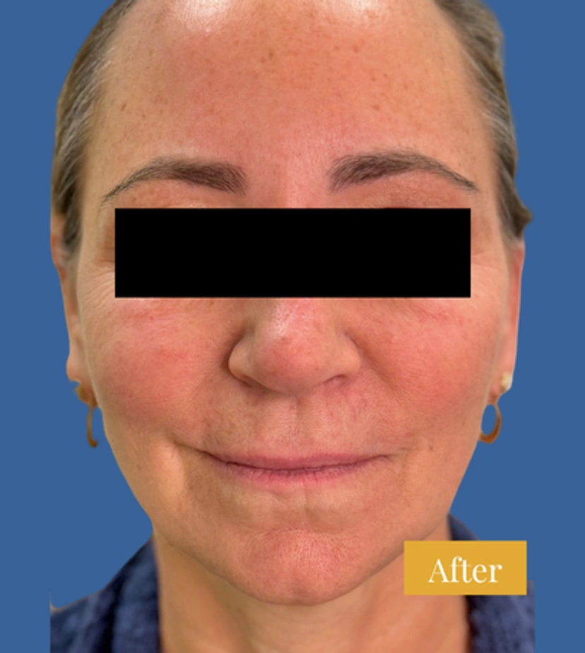 Sculptra - Patient 4 - Set 1 - After
