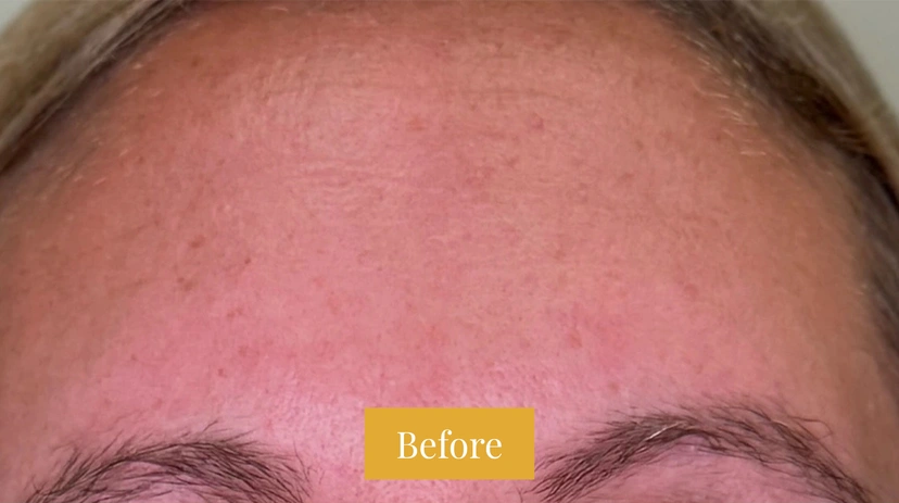 Fraxel - Patient 4 - Set 1 - Before