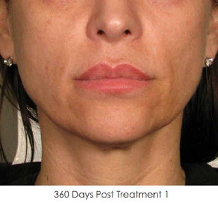 Ultherapy patient 4 result photo