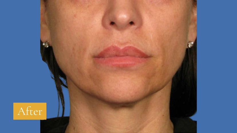 Ultherapy patient 4 result photo