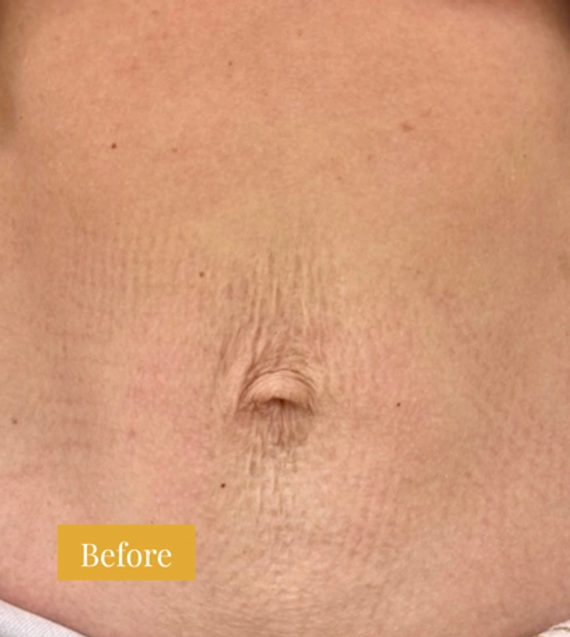 Fraxel - Patient 5 - Set 1 - Before