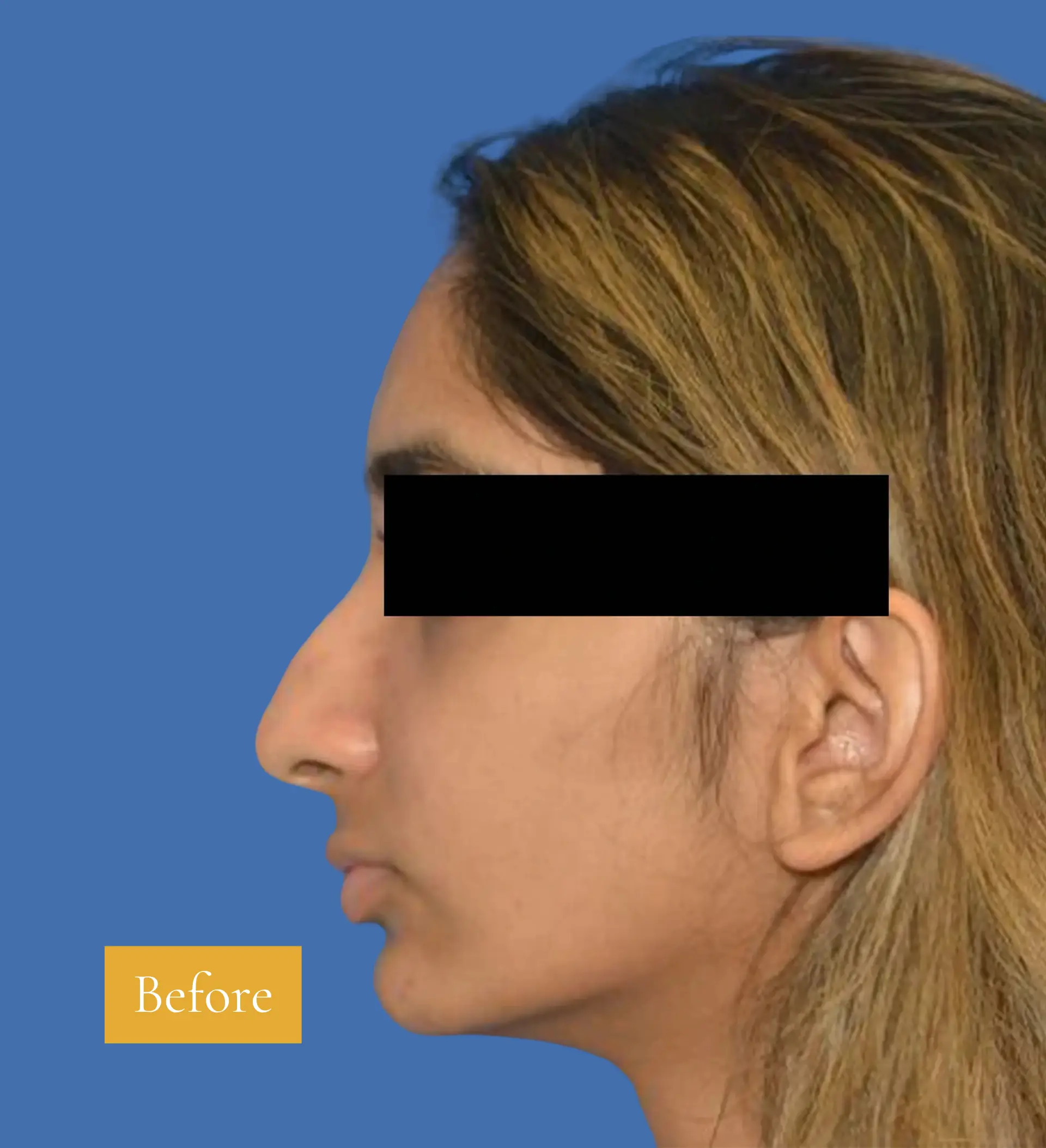 Before Rhinoplasty before and after - Patient 7