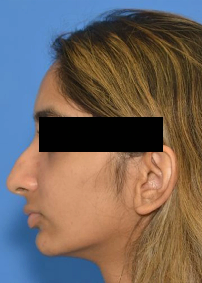 Rhinoplasty - Patient 7 (side view left before)