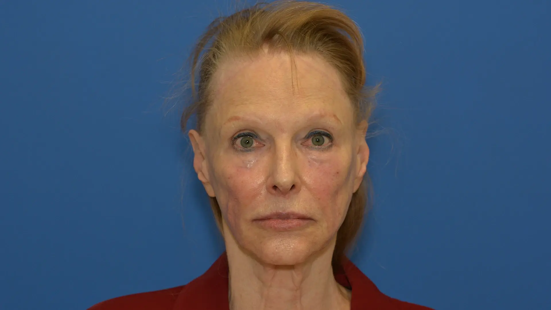 Before Voluma before and after