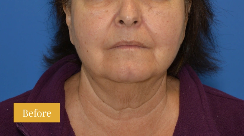 Facelift - Patient 7 - Set 1 - Before