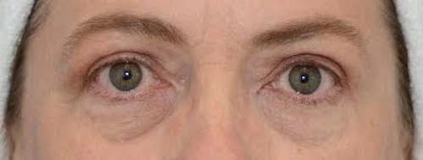 Upper Eyelid Surgery - Patient 2 (after)