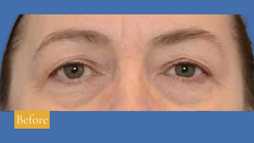 Upper Eyelid Surgery - Patient 2 (after)