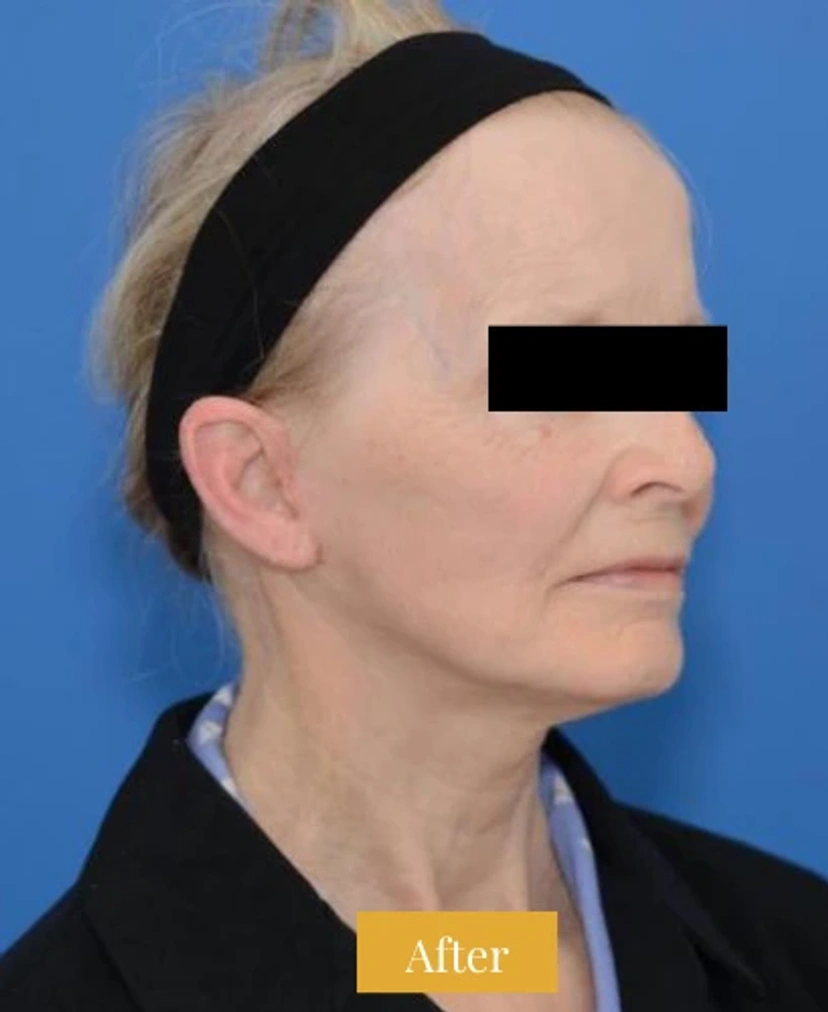 Mini Facelift/Short Scar - Patient 4 (half-turn right view after)