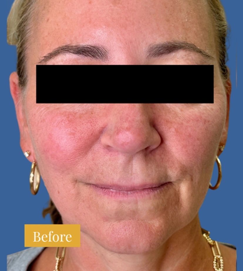 Sculptra - Patient 4 - Set 1 - Before