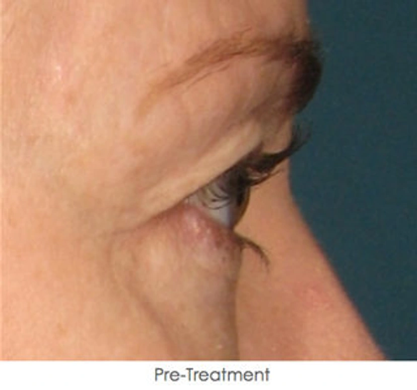 Ultherapy patient 1 result photo