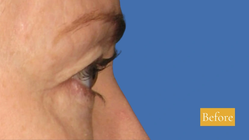 Ultherapy patient 1 result photo