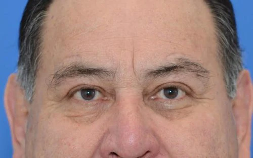 After Blepharoplasty before and after