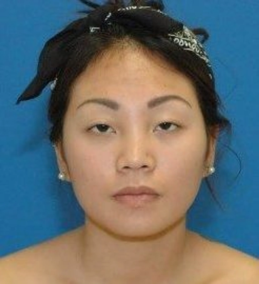 Asian Rhinoplasty - Patient 1 (front view before)