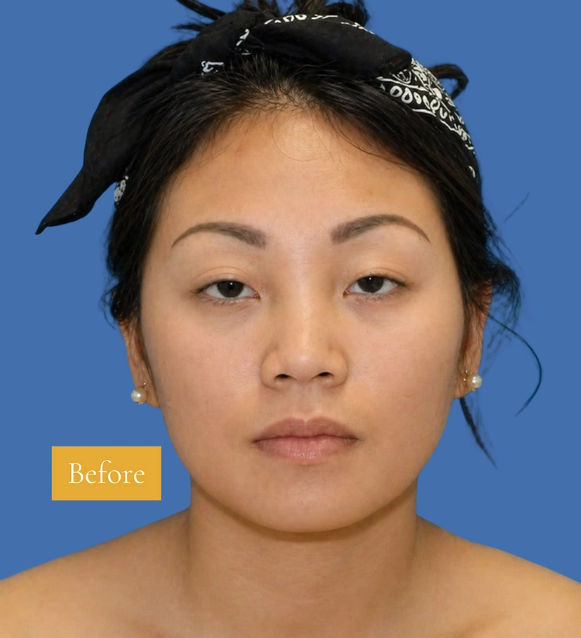 Asian Rhinoplasty - Patient 1 (front view before)