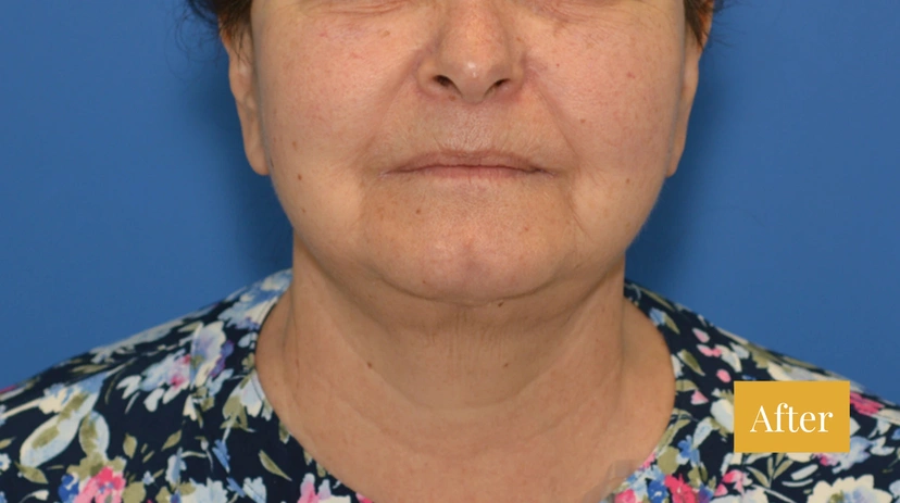 Facelift - Patient 7 - Set 1 - After