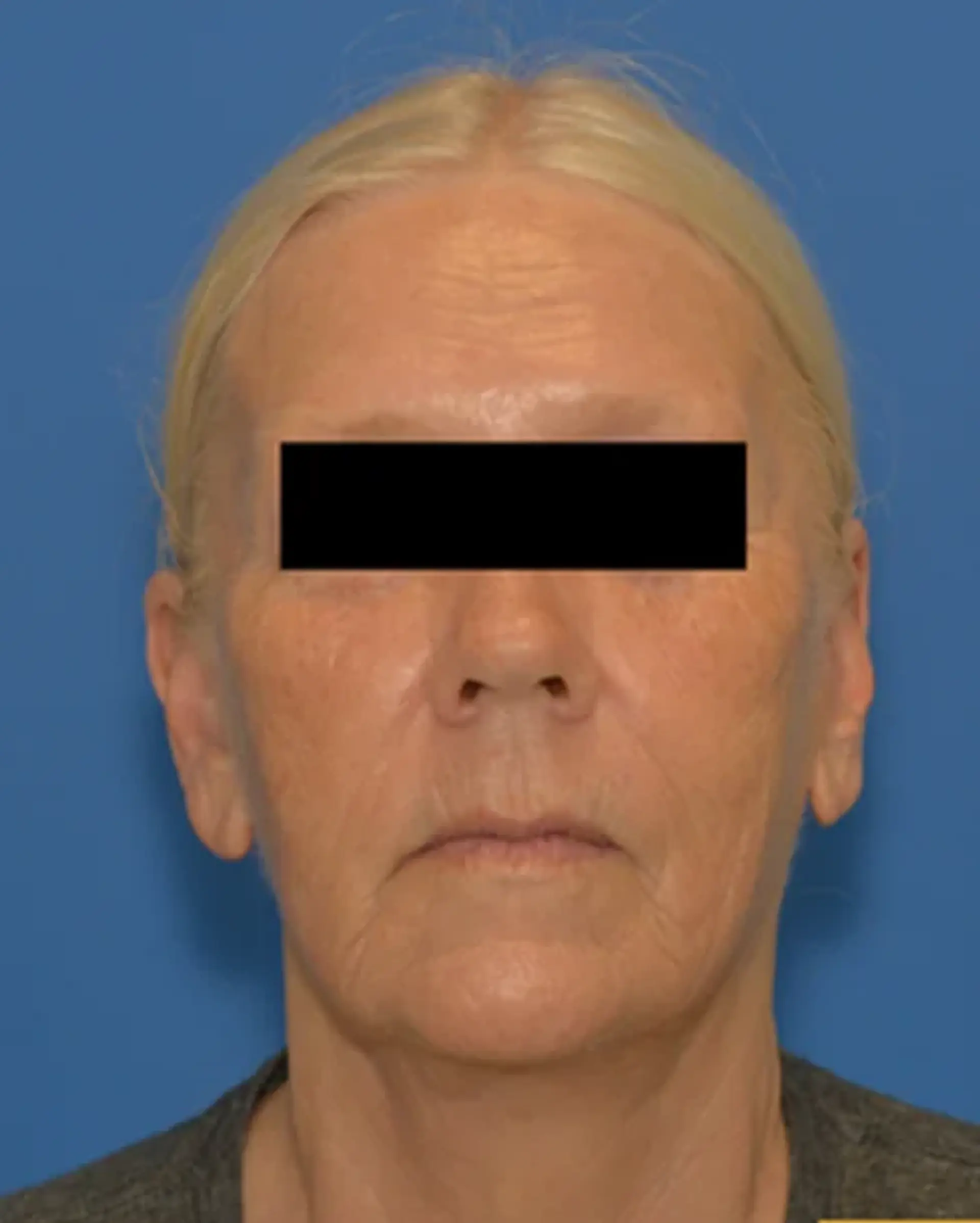 After Facelift before and after