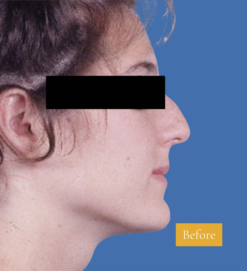 Rhinoplasty - Patient 4 (before)