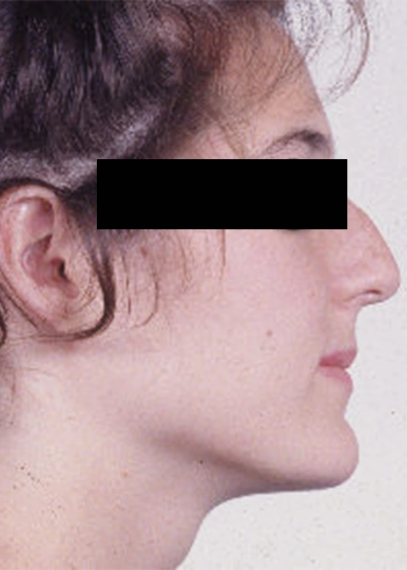 Rhinoplasty - Patient 4 (before)