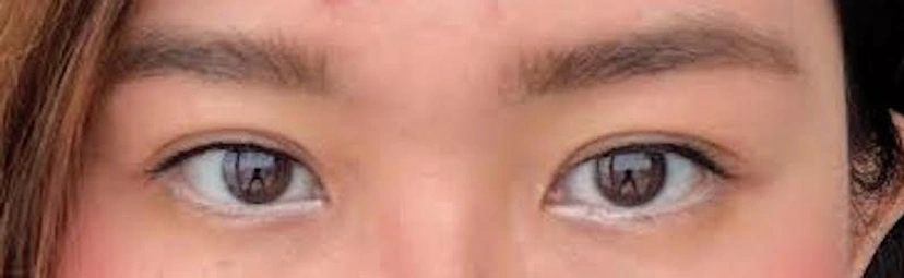 Asian eyelid surgery patient 62 result photo