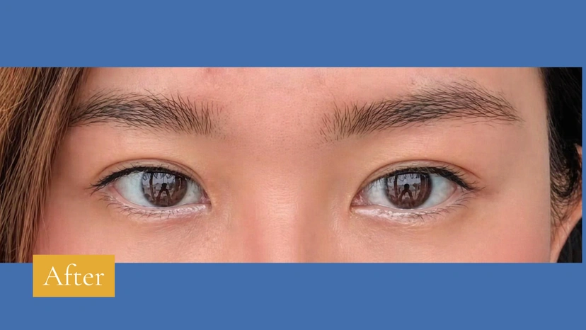 Asian eyelid surgery patient 62 result photo