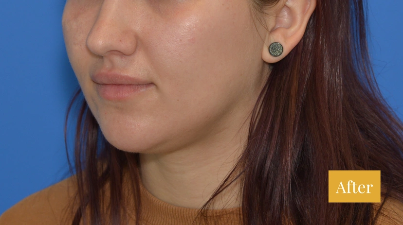 Microneedling - Patient 5 - Set 1 - After