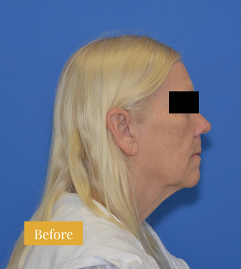 Neck Lift - Patient 2 - Set 1 - Before