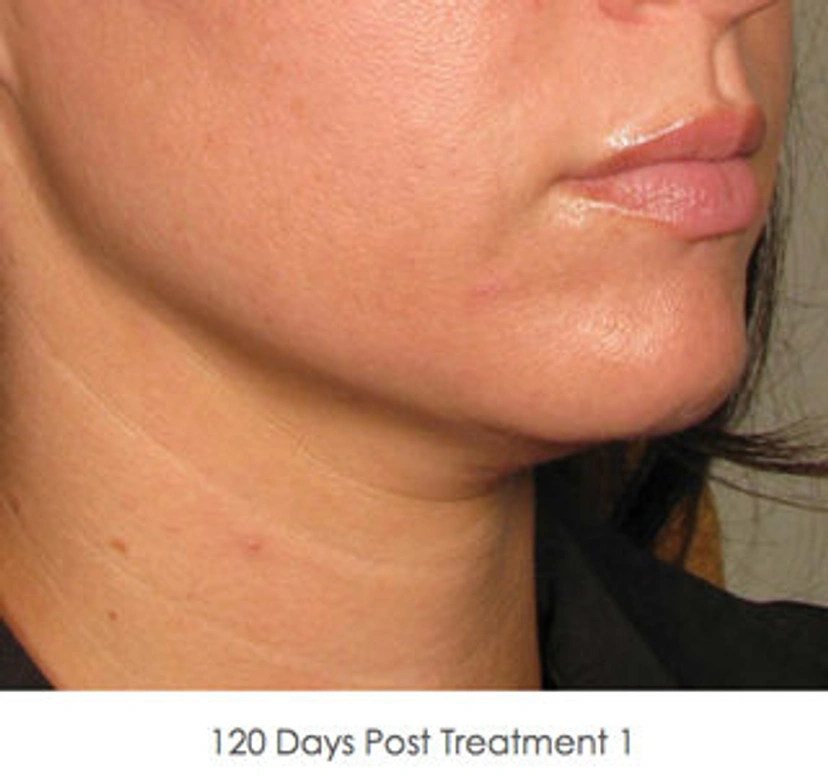 Ultherapy patient 1 result photo