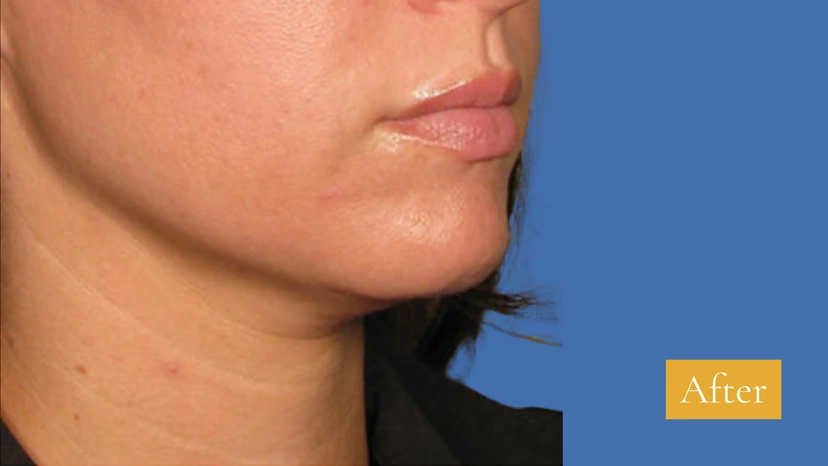 Ultherapy patient 1 result photo