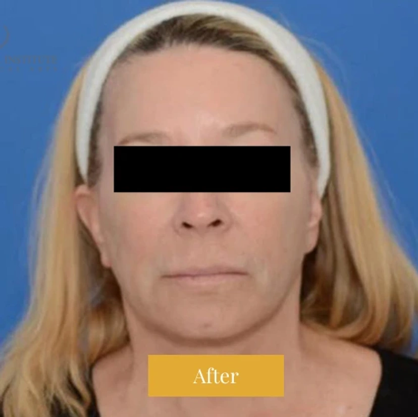 Mini Facelift/Short Scar - Patient 2 (after)