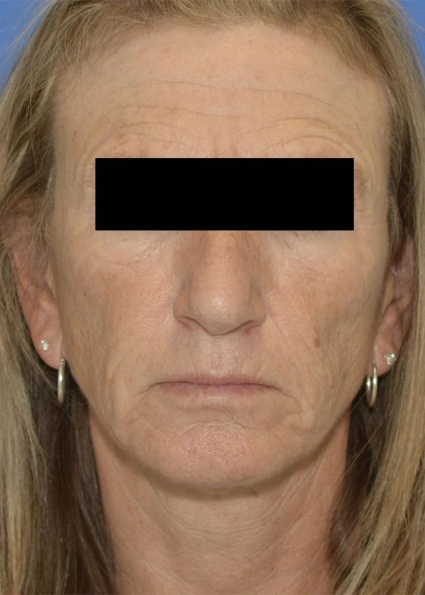 Botox - Patient 5 (front view before)