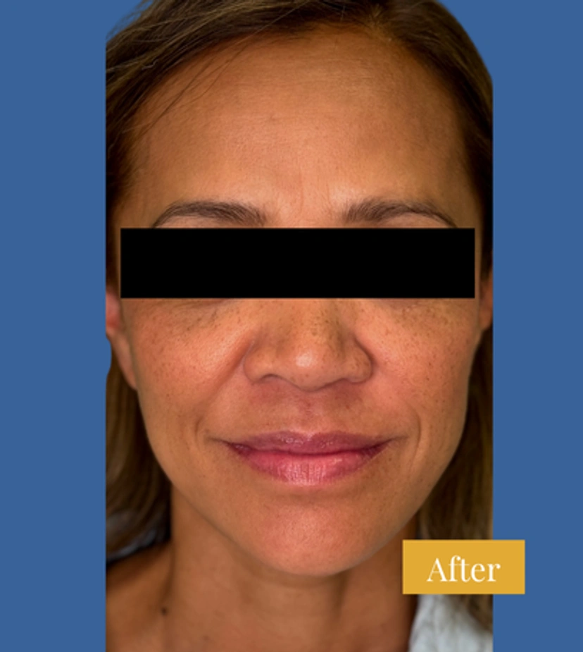 Sculptra - Patient 3 - Set 1 - After
