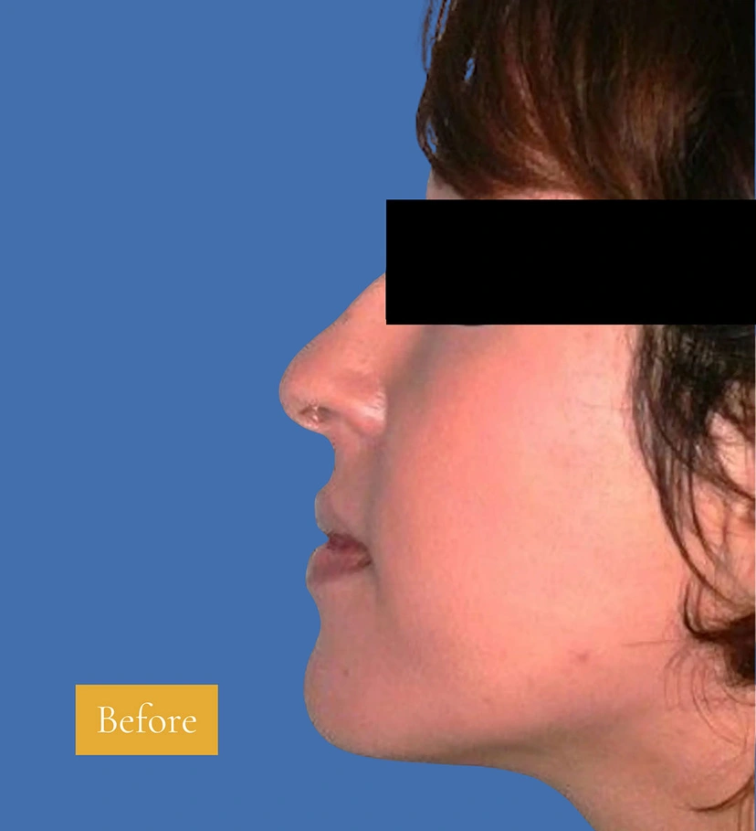 Rhinoplasty - Patient 1 (before)