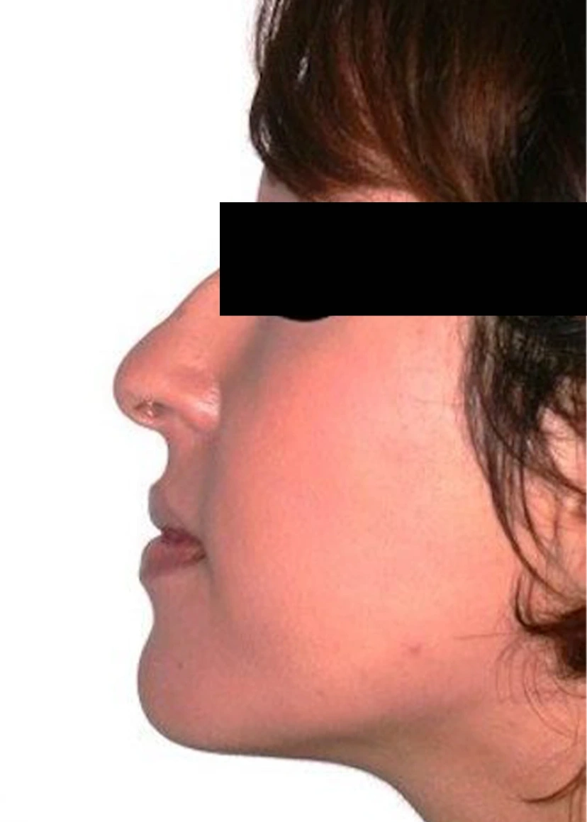 Rhinoplasty - Patient 1 (before)