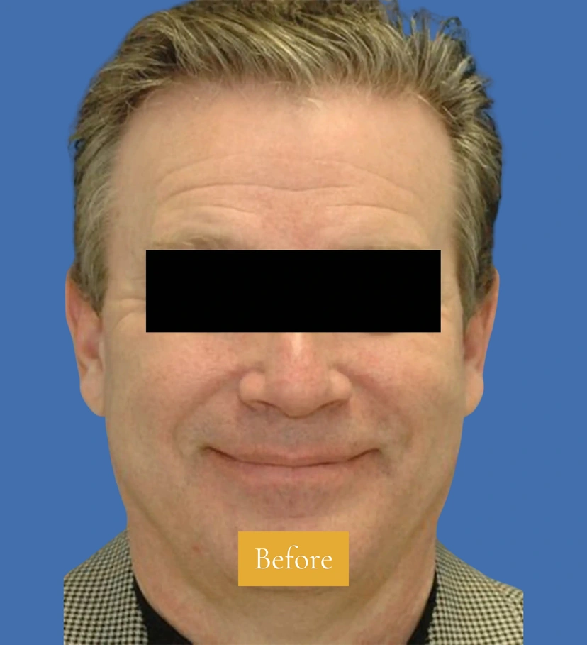 Botox - Patient 1 (front view before)