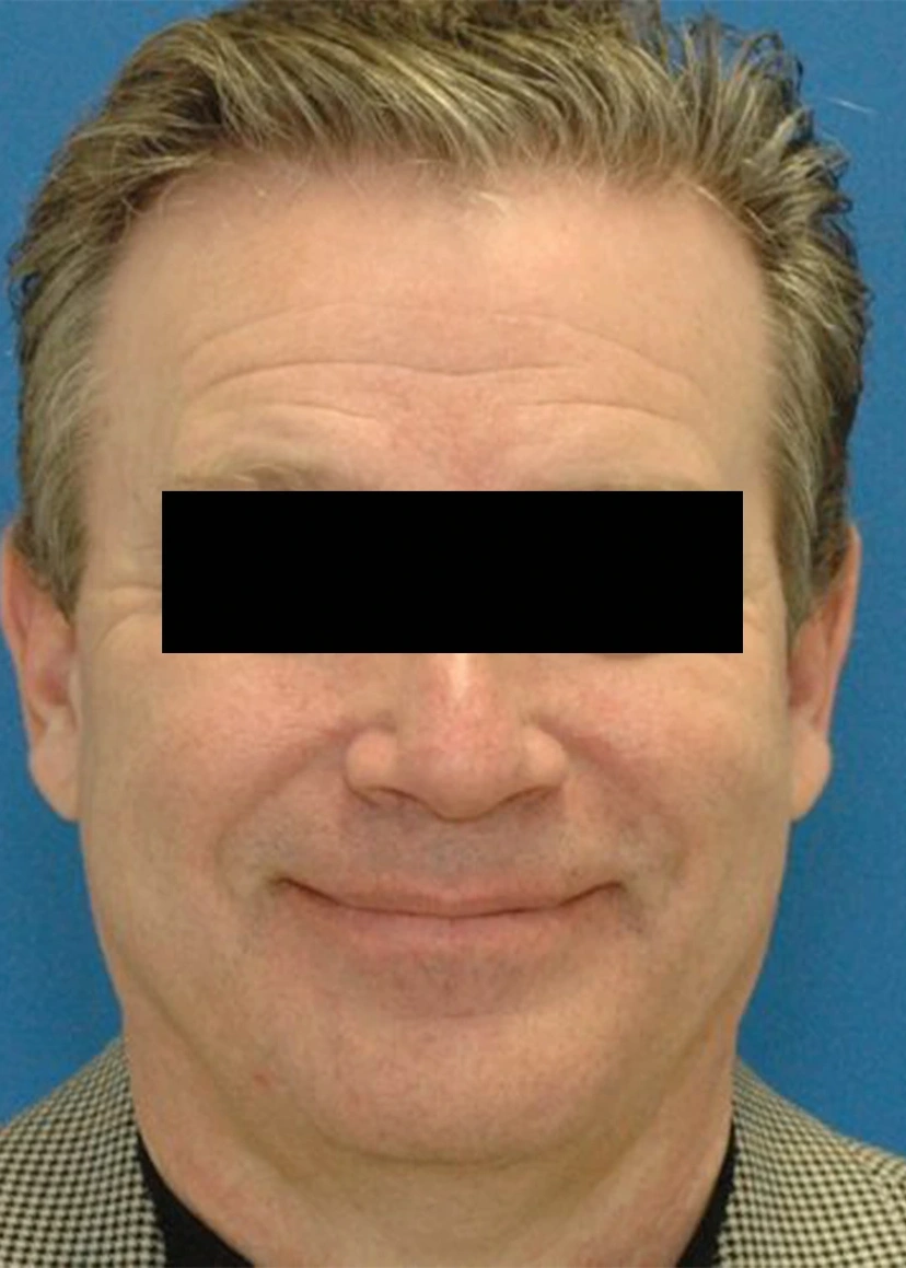 Botox - Patient 1 (front view before)