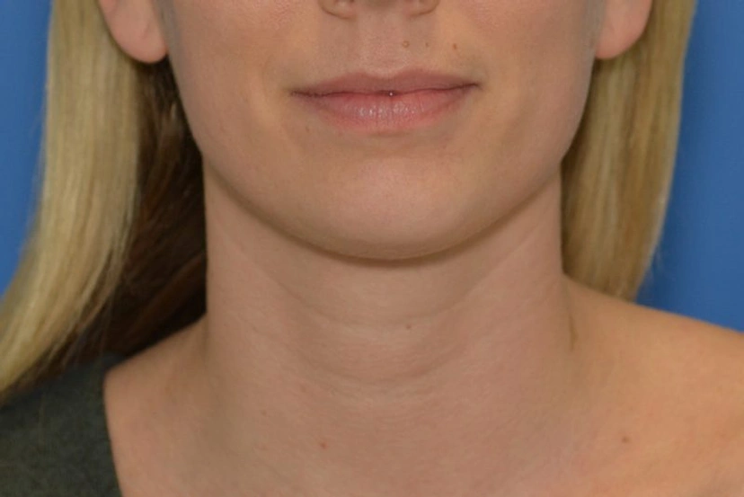 Morpheus8 RF Microneedling - Patient 6 (before)