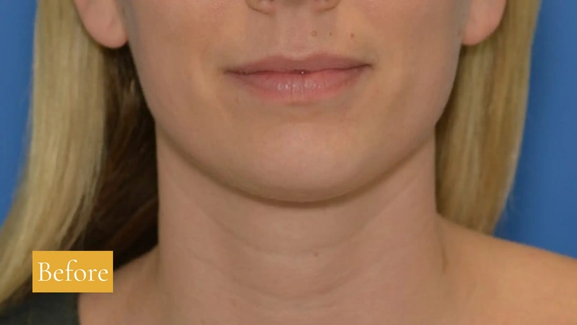 Morpheus8 RF Microneedling - Patient 6 (before)
