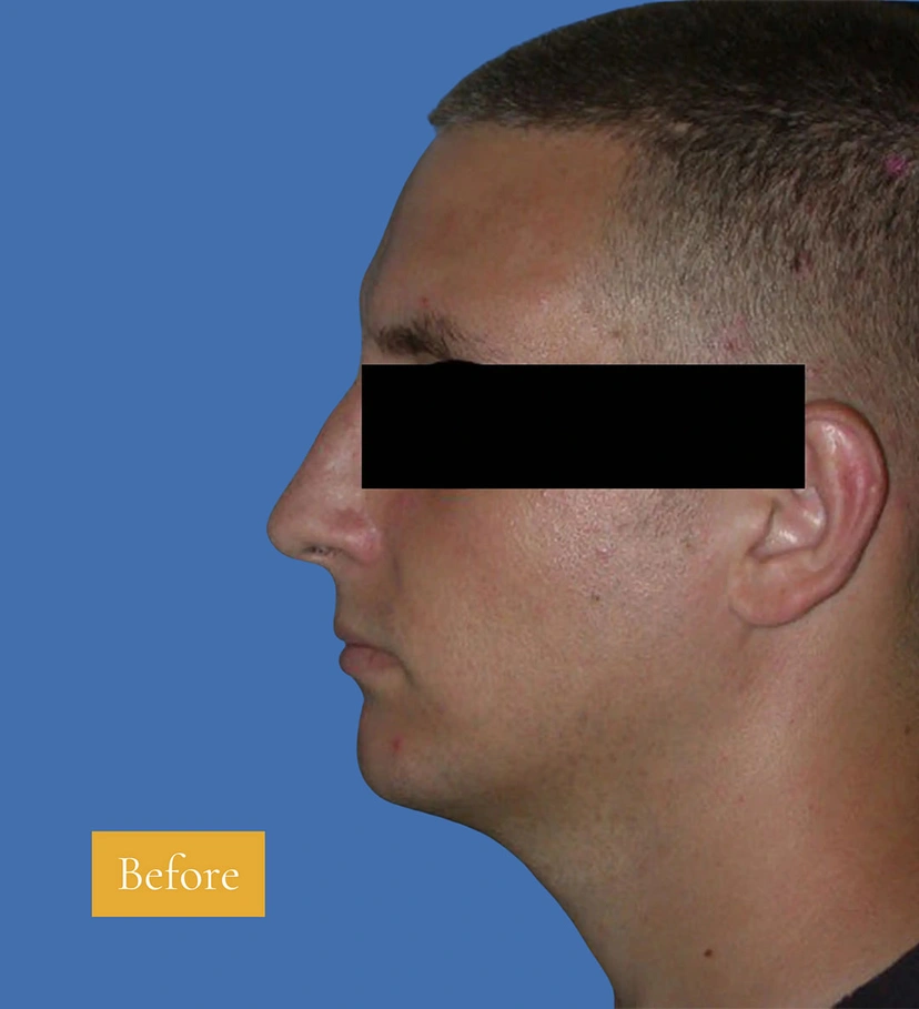 Rhinoplasty - Patient 2 (after)