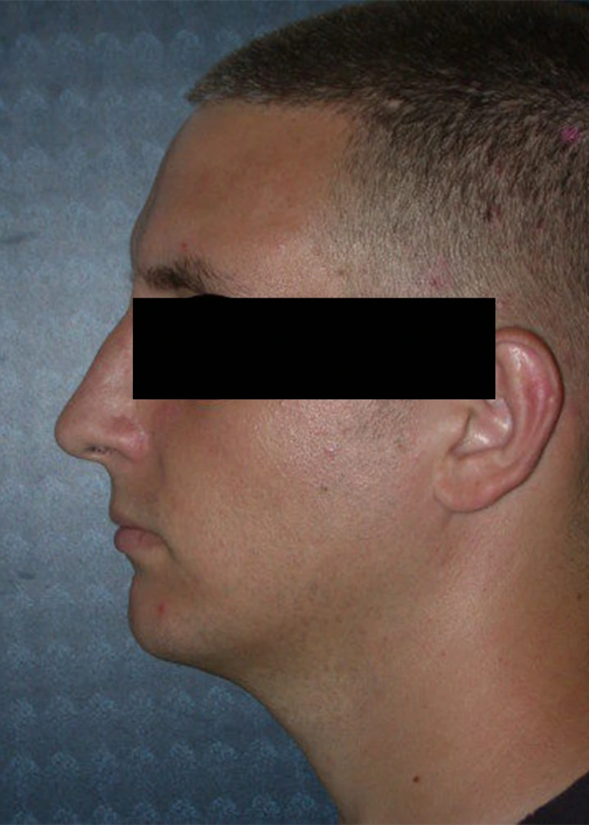 Rhinoplasty - Patient 2 (after)