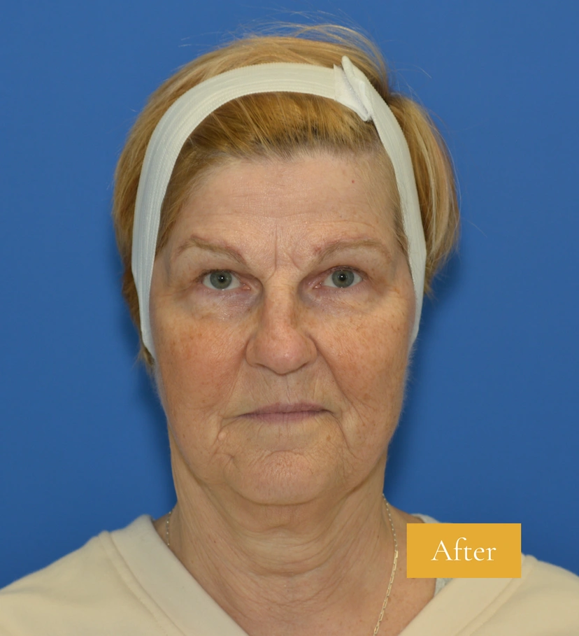 Eyebrow Lift - Patient 4 - Set 1 - After