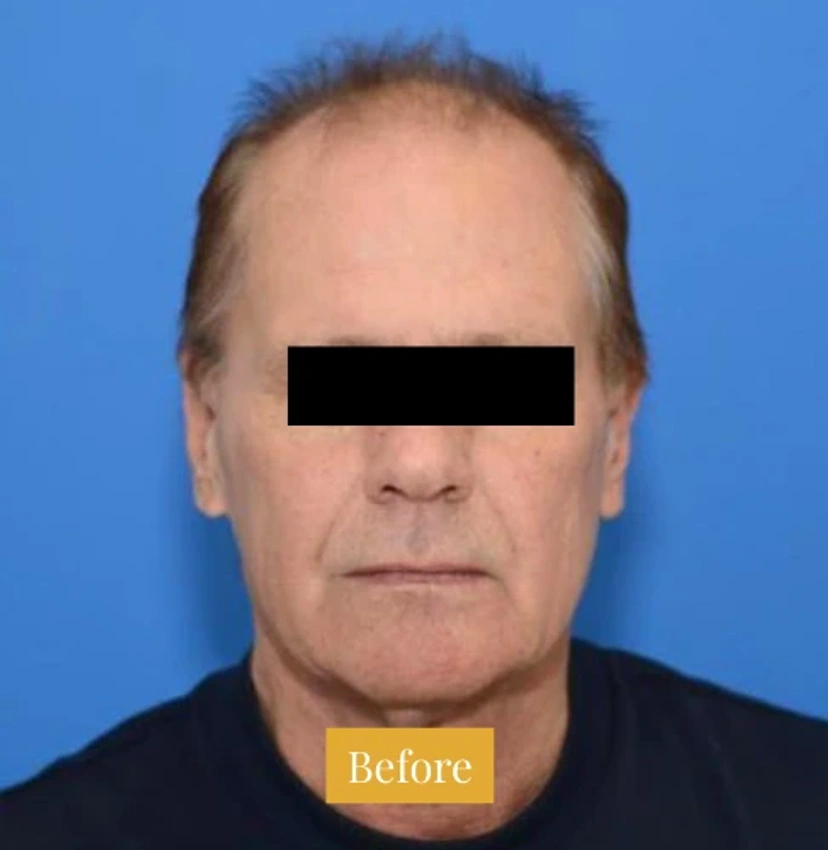 Mini Facelift/Short Scar - Patient 3 (front view before)