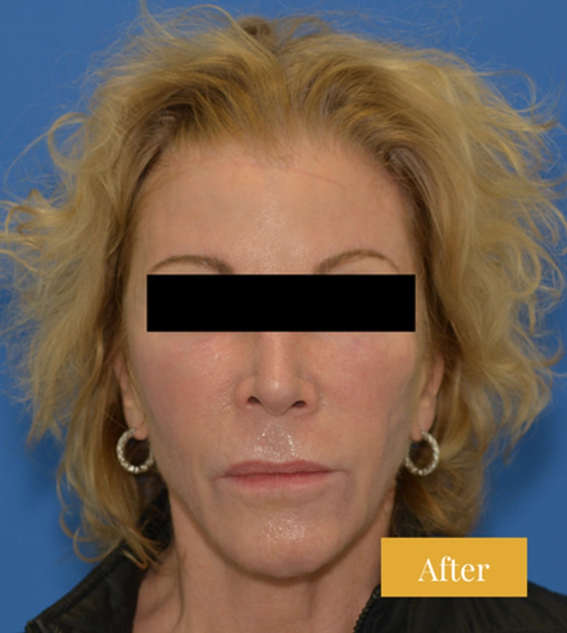 Eyebrow Lift - Patient 2 - Set 1 - After