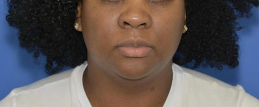 Microneedling - Patient 1 (front view after)