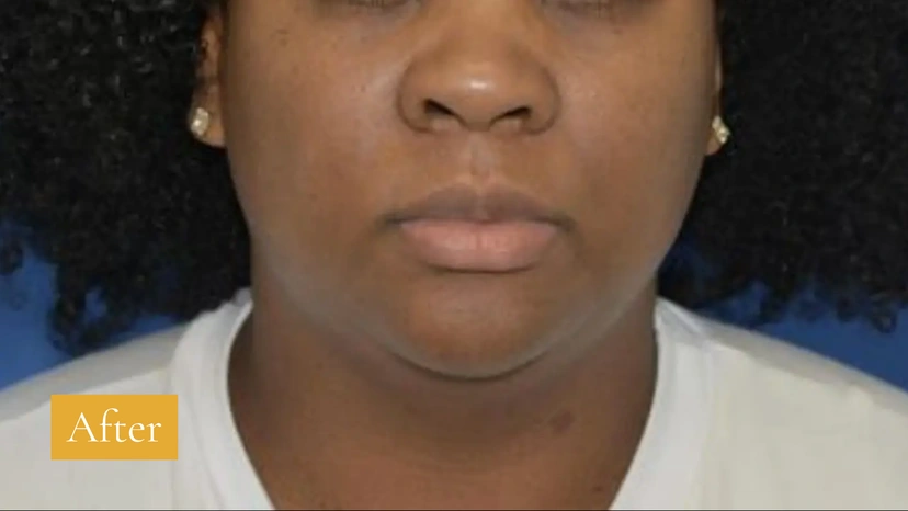 Microneedling - Patient 1 (front view after)