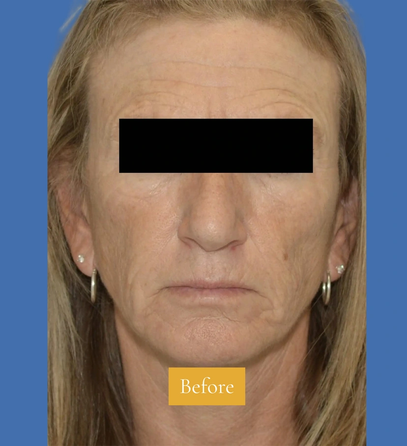 Dermal Fillers - Patient 4 (before)