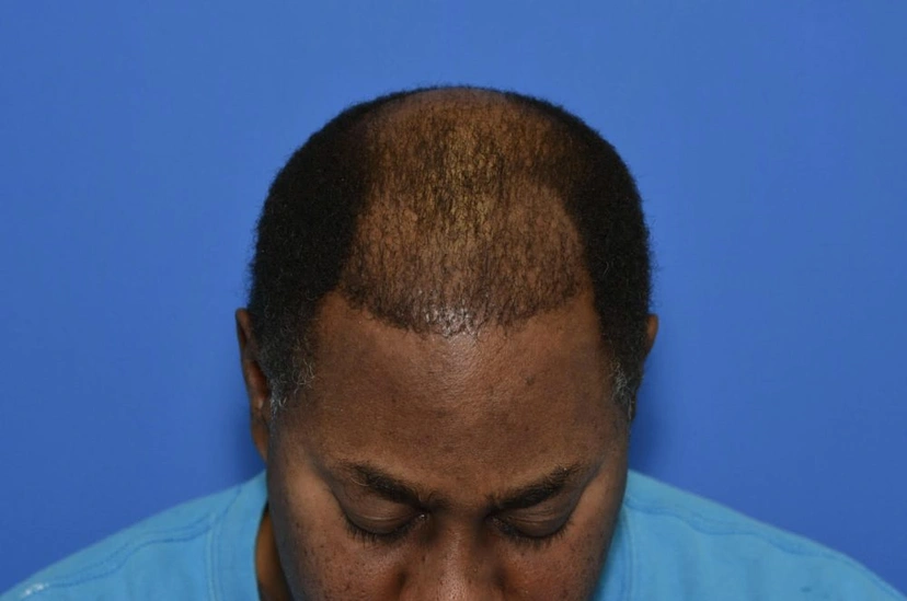 Hair Restoration - Patient 2 (before)