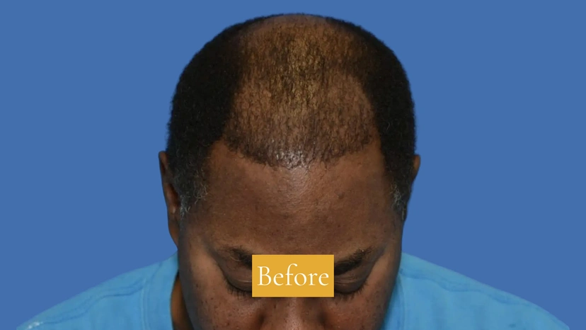 Hair Restoration - Patient 2 (before)